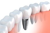 Dental Implant